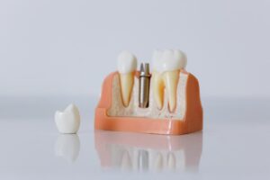 Przeciwwskazania do implantów dentystycznych