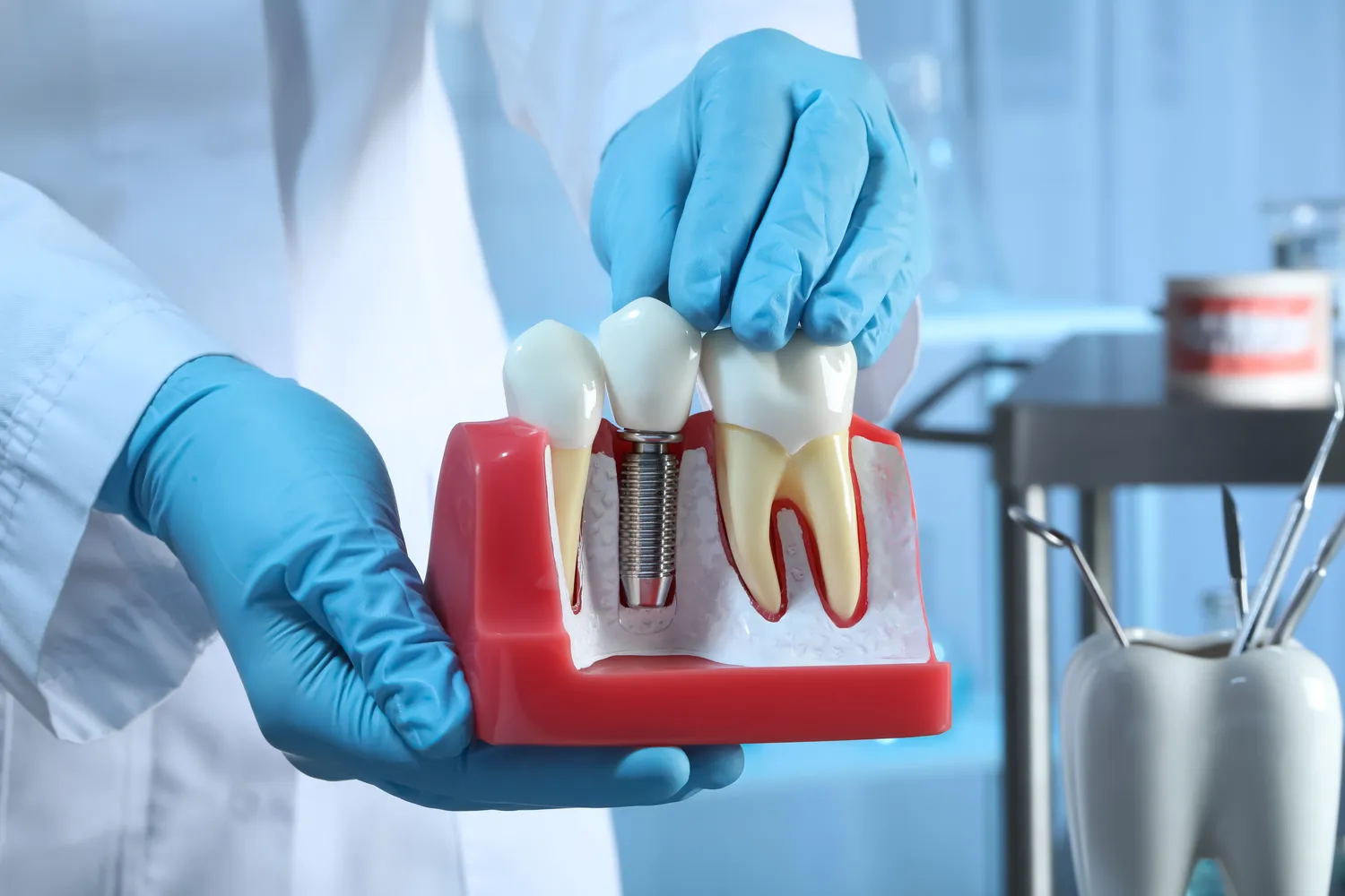 Rodzaje implantów zębowych
